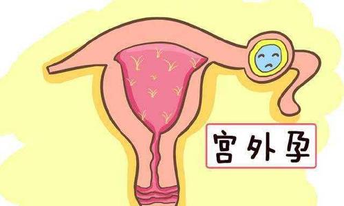 宫外孕症状检查治疗注意事项